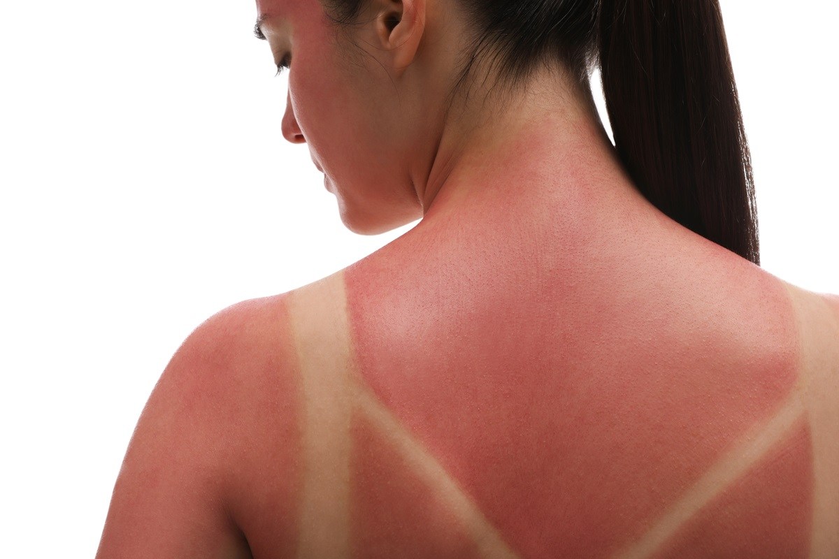 Common Health Problems When Traveling Abroad - Sunburn